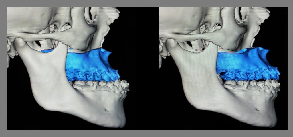 Planeación virtual 3D en cirugía ortognática