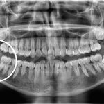 Caso Romdi – Fractura de mandíbula posterior a extracción de tercer molar